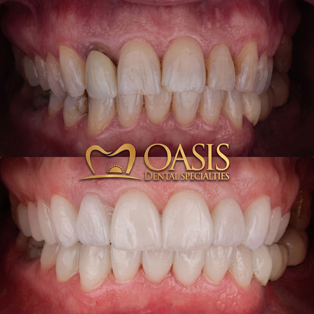 Before and After patient at Oasis Dental Specialties