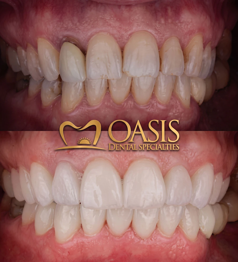 Before and After patient at Oasis Dental Specialties
