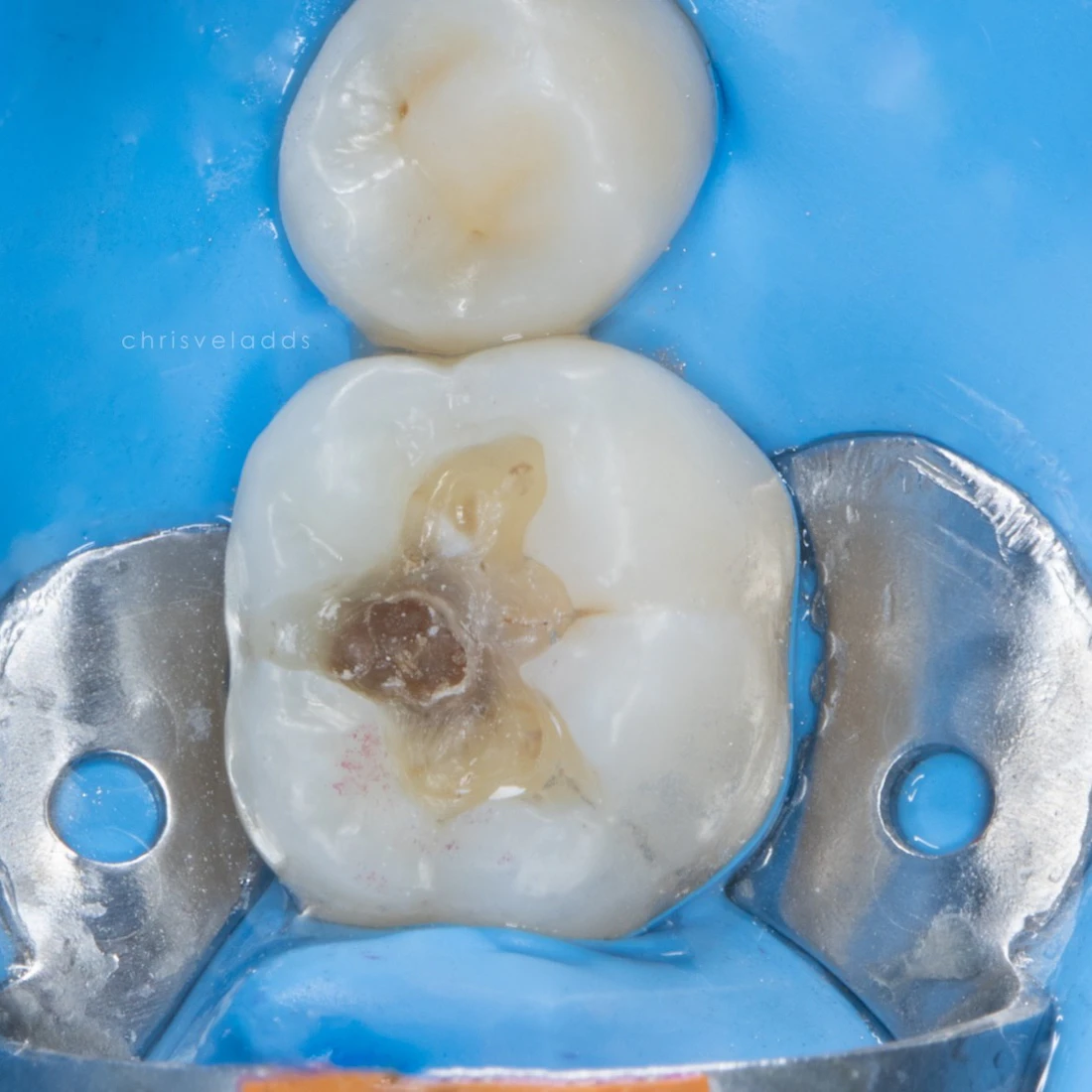 Molar isolated with a dental dam after the old amalgam filling and decay were removed
