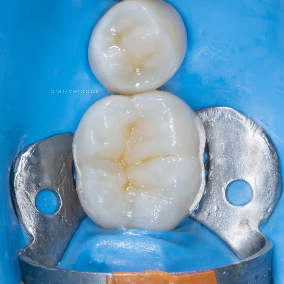 Molar restored with a tooth-colored composite filling while still isolated