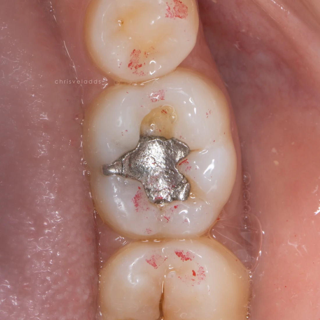 Real patient molar with a worn silver amalgam filling and visible decay, before treatment