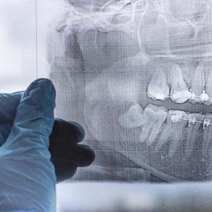 X-ray of an impacted wisdom tooth