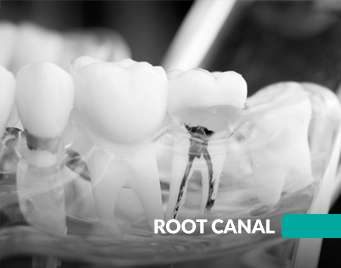 root canal