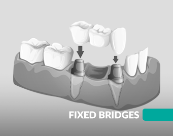 Fixed Bridges