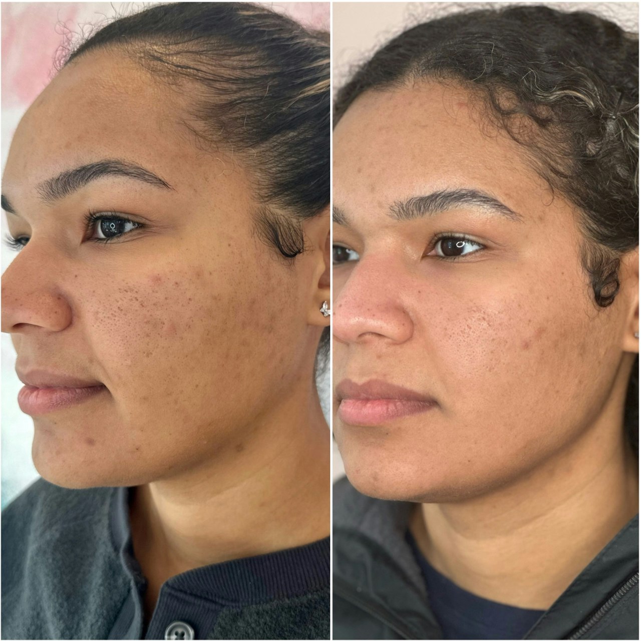 Before and After laser skin resurfacing in Rumson