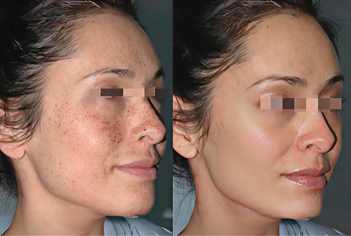 before and after IPL Photofacial