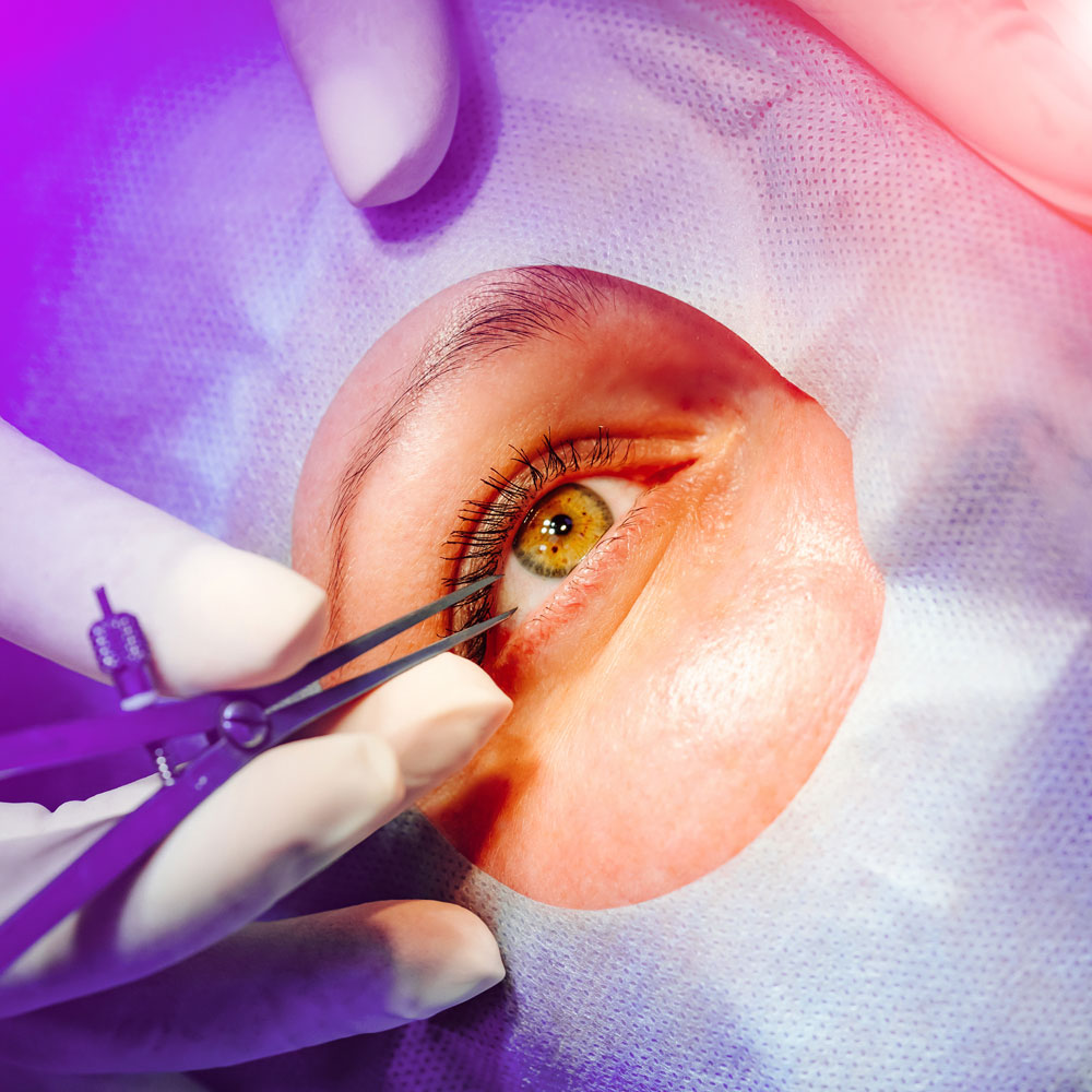 LASIK eye surgery