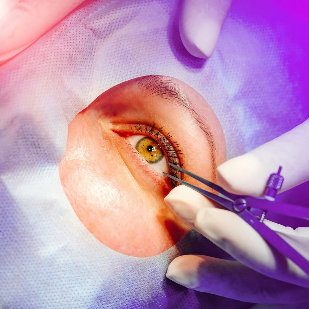 Eye surgery