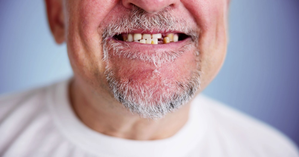 man with missing tooth