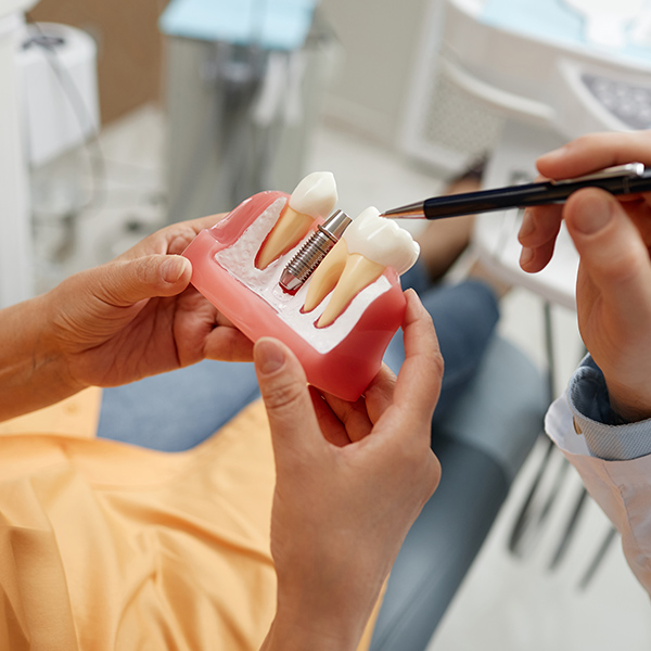 dental implant model