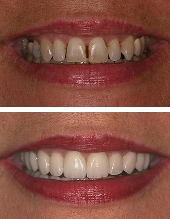 Dr. Steve Gorman's patient before and after dental crowns