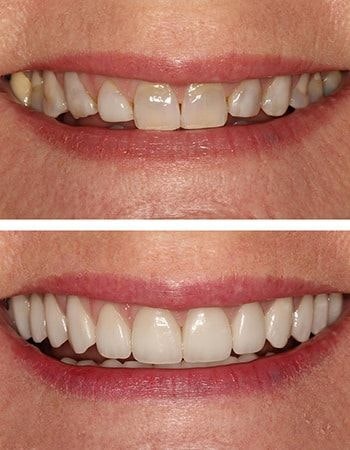 Dental crowns results