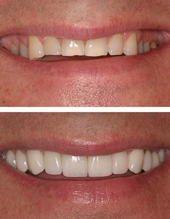 Dental crowns results