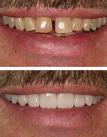 Dental crowns results