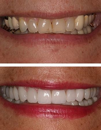 Dental crowns results