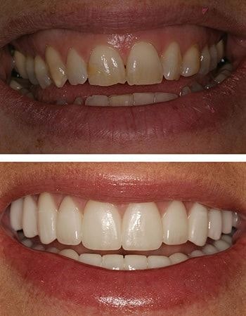 Dental crowns results