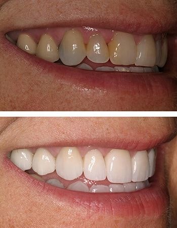 Dental crowns results