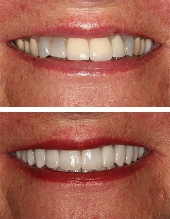 Dental crowns results