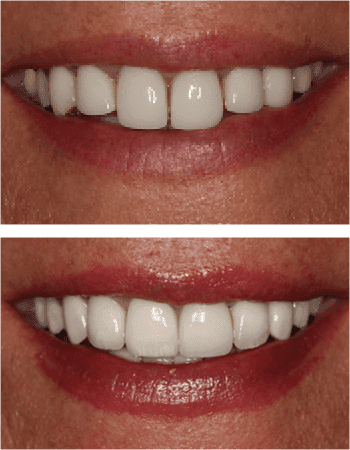 Dental implant results