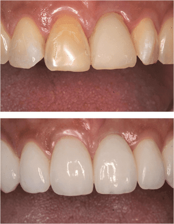 Dental implant results