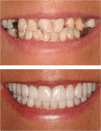 Dental implant results