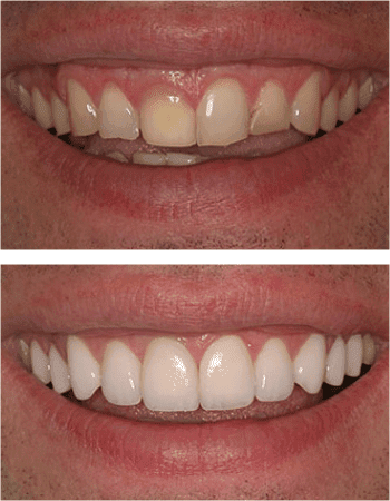 Dental implant results