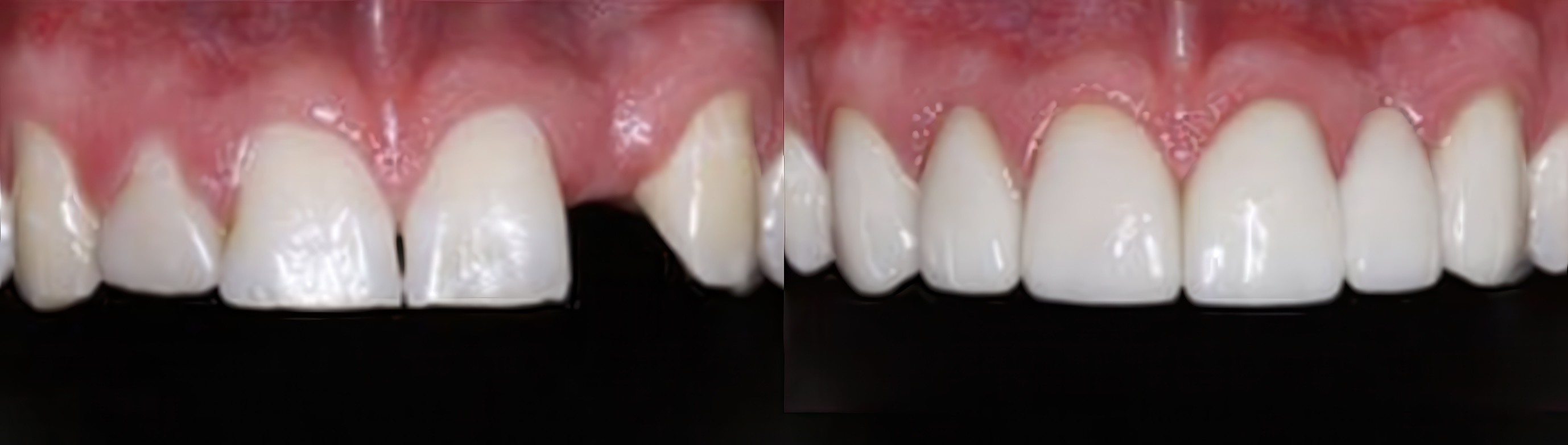 Before-and-after image showing dental crown treatment. The left side depicts natural upper front teeth with visible gaps and irregular shapes. The right side shows the same teeth after treatment, appearing more uniform, aligned, and whiter with closed gaps.