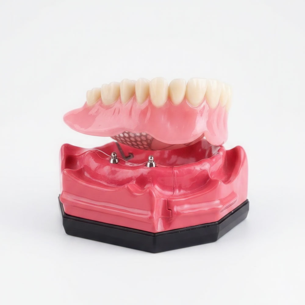 Model of snap in dentures