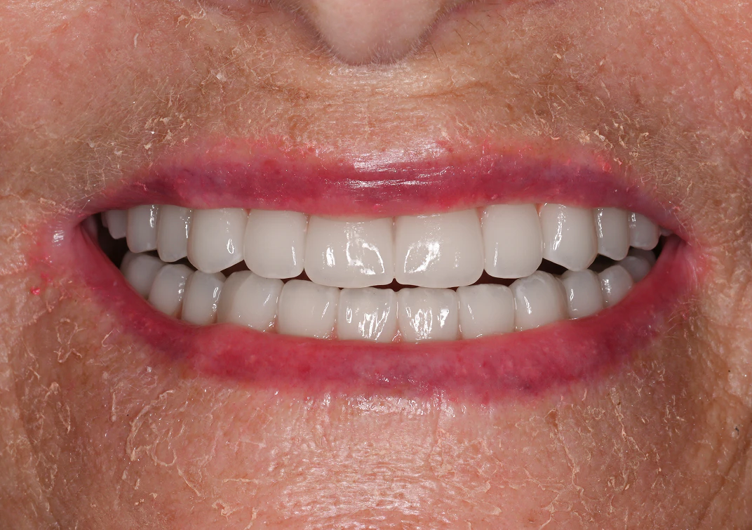 After All-on-4 image of a real patient from Montz and Maher Dental Group