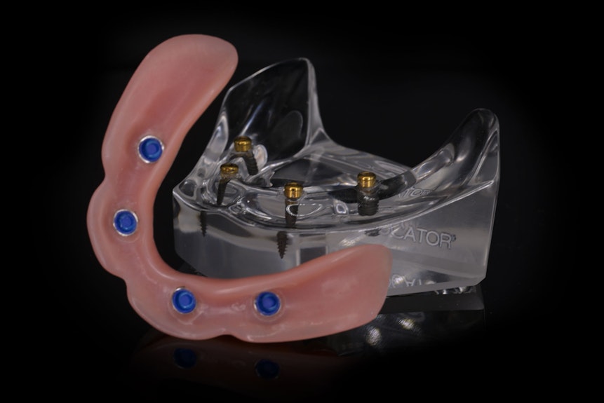 Model of All-on-4 Dental Implants at Montz and Maher Dental Group