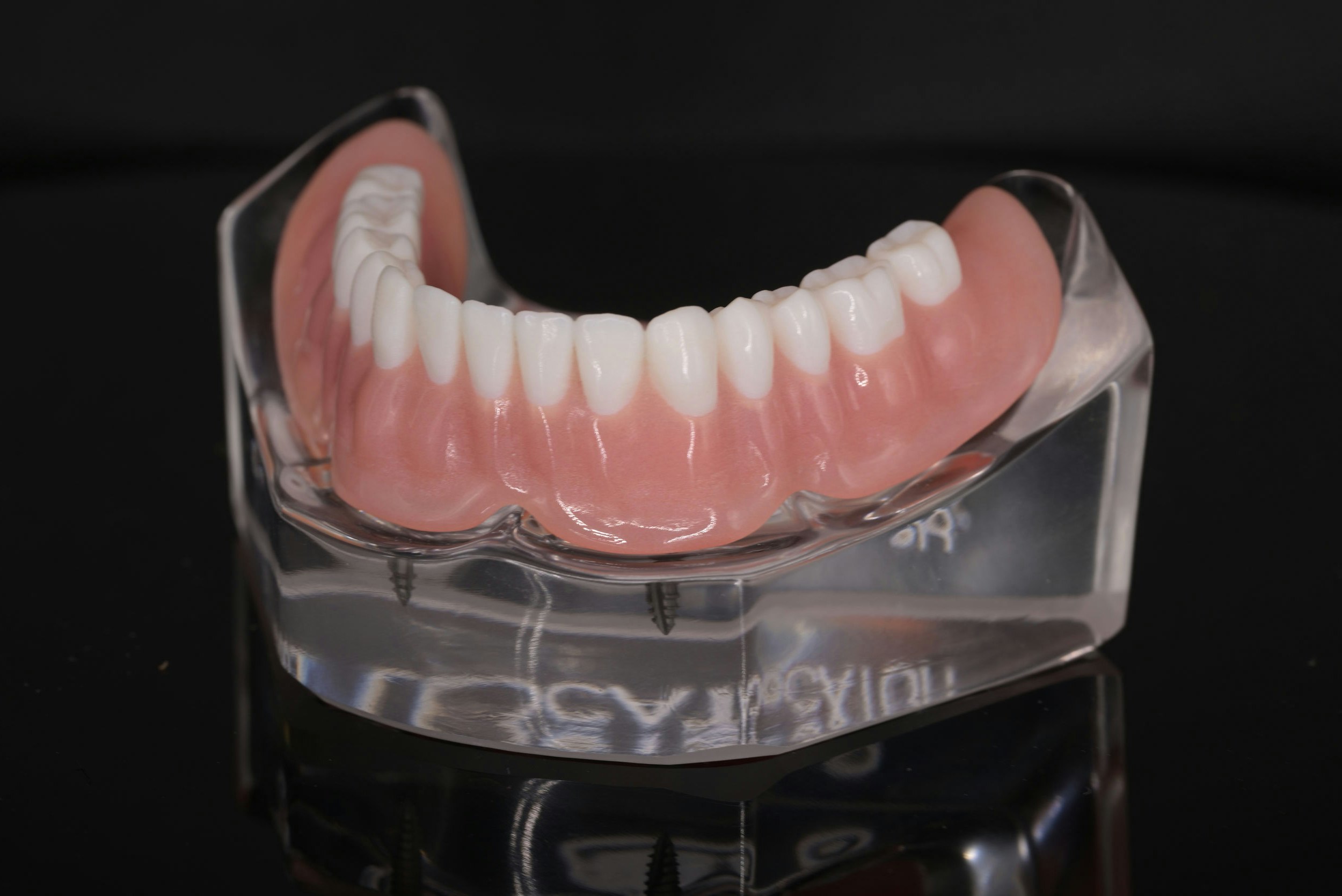 Model of Implant Supported Dentures at Montz and Maher Dental Group