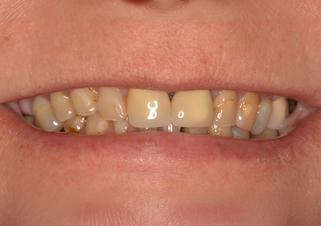 Before All-on-4 image of a real patient from Montz and Maher Dental Group