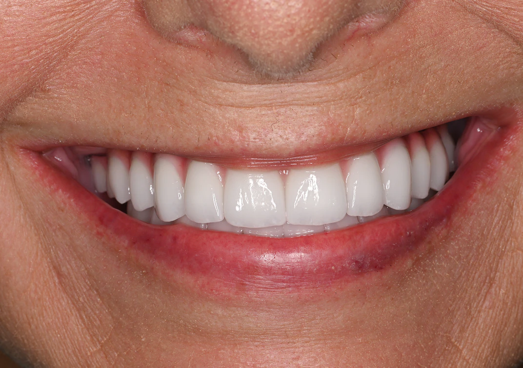 After All-on-4 image of a real patient from Montz and Maher Dental Group