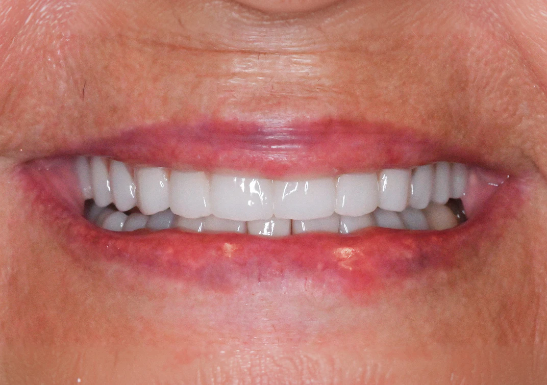 After All-on-4 image of a real patient from Montz and Maher Dental Group