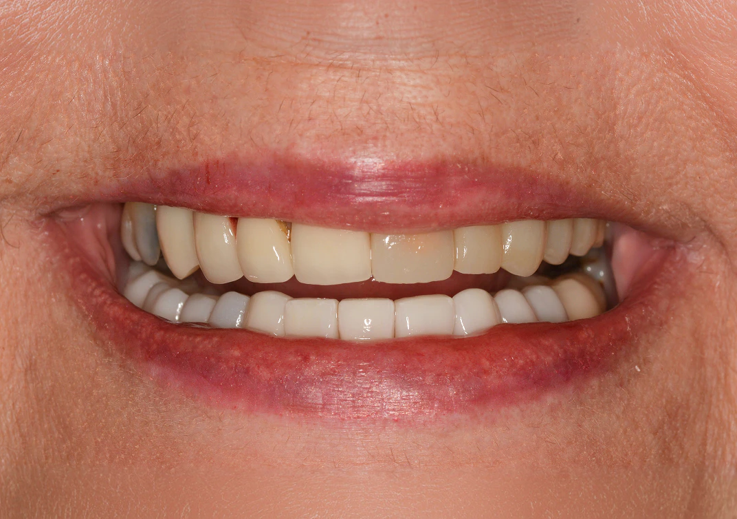 Before All-on-4 image of a real patient from Montz and Maher Dental Group