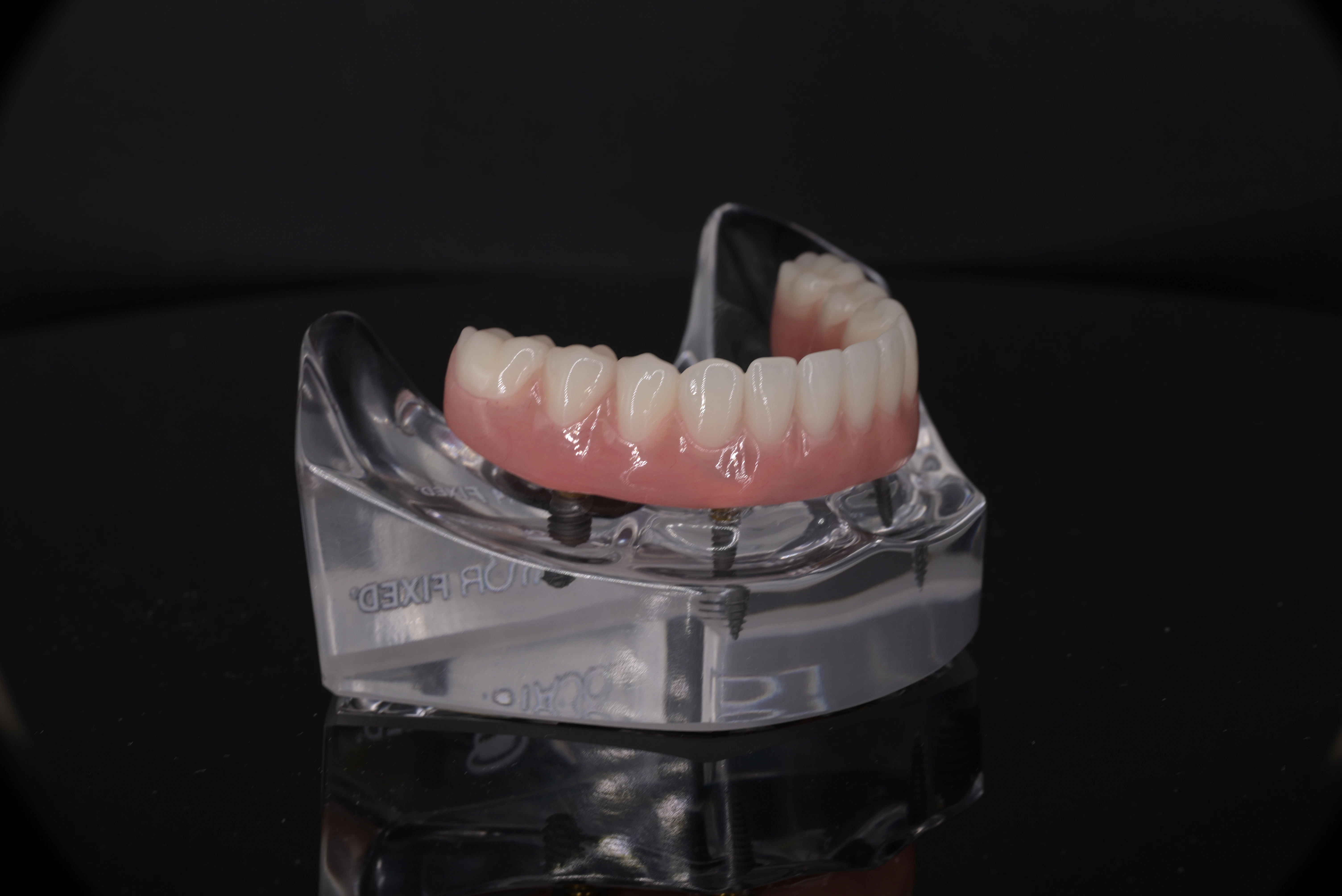Model of fixed full arch implants at Montz and Maher Dental Group