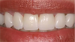 After dentures image of real patient at Montz and Maher Dental Group