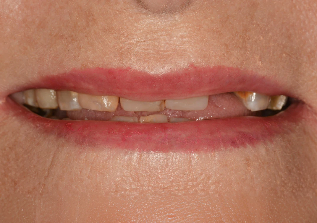 Before dentures image of real patient at Montz and Maher Dental Group