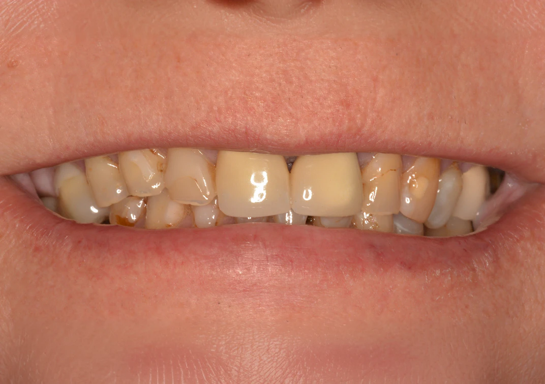 Before dentures image of real patient at Montz and Maher Dental Group