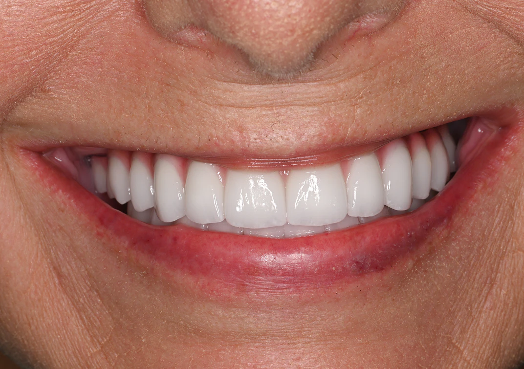 after dentures image of real patient at Montz and Maher Dental Group