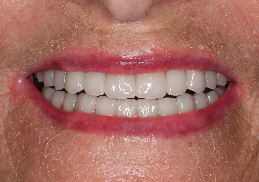 after dentures image of real patient at Montz and Maher Dental Group