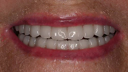 after dentures image of real patient at Montz and Maher Dental Group