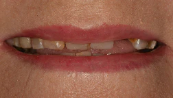 Before dentures image of real patient at Montz and Maher Dental Group