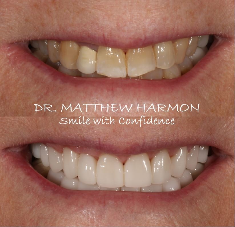 Dr. Matthew Harmon real patient before & after case 2