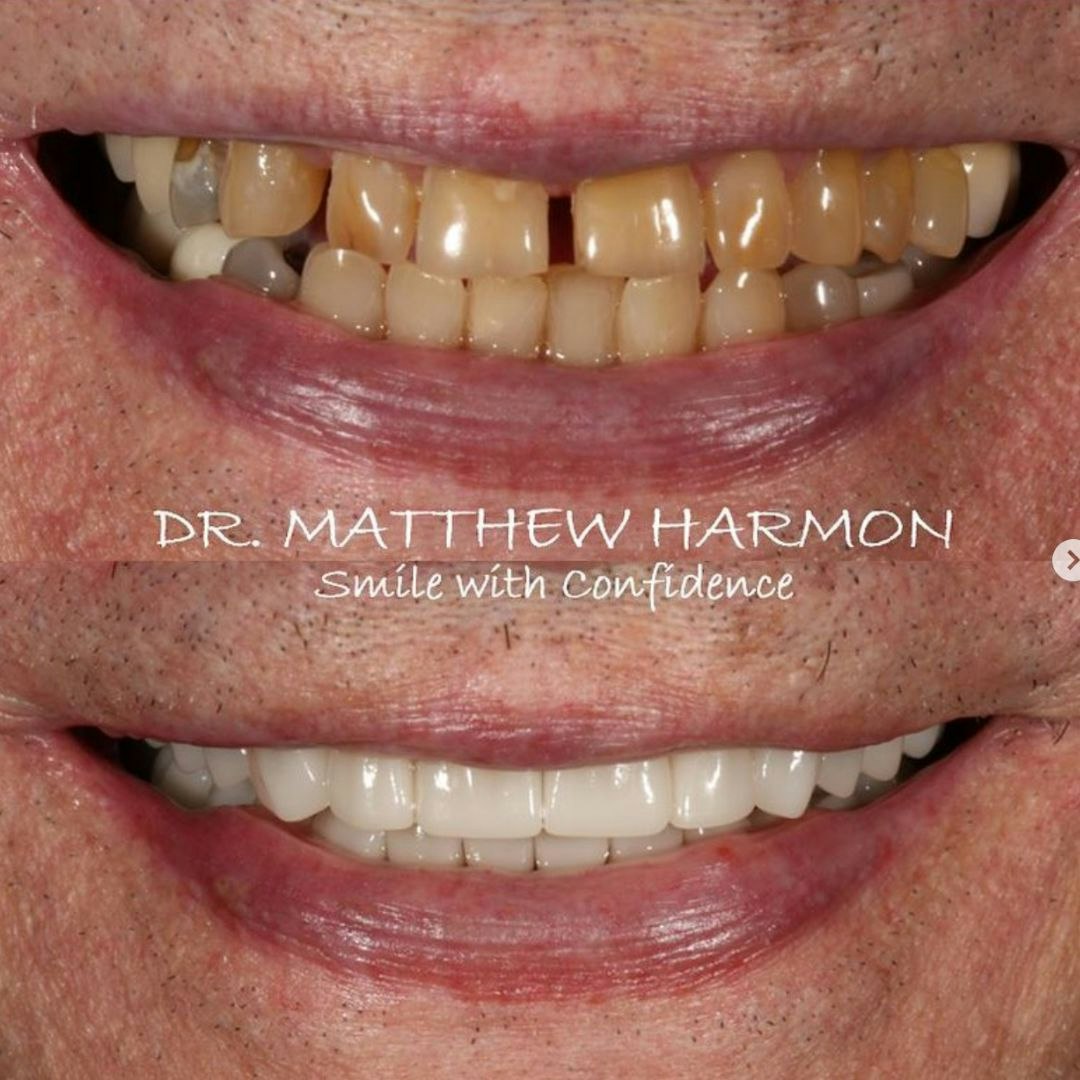 Dr. Matthew Harmon real patient before & after