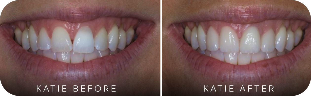 before and after cosmetic dentistry