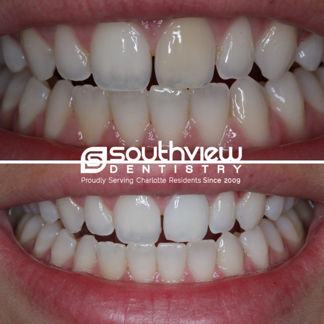 Teeth Whitening Before & After Case 3