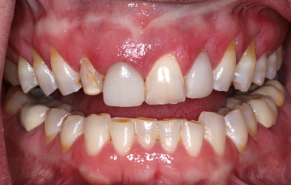 Before smile makeover