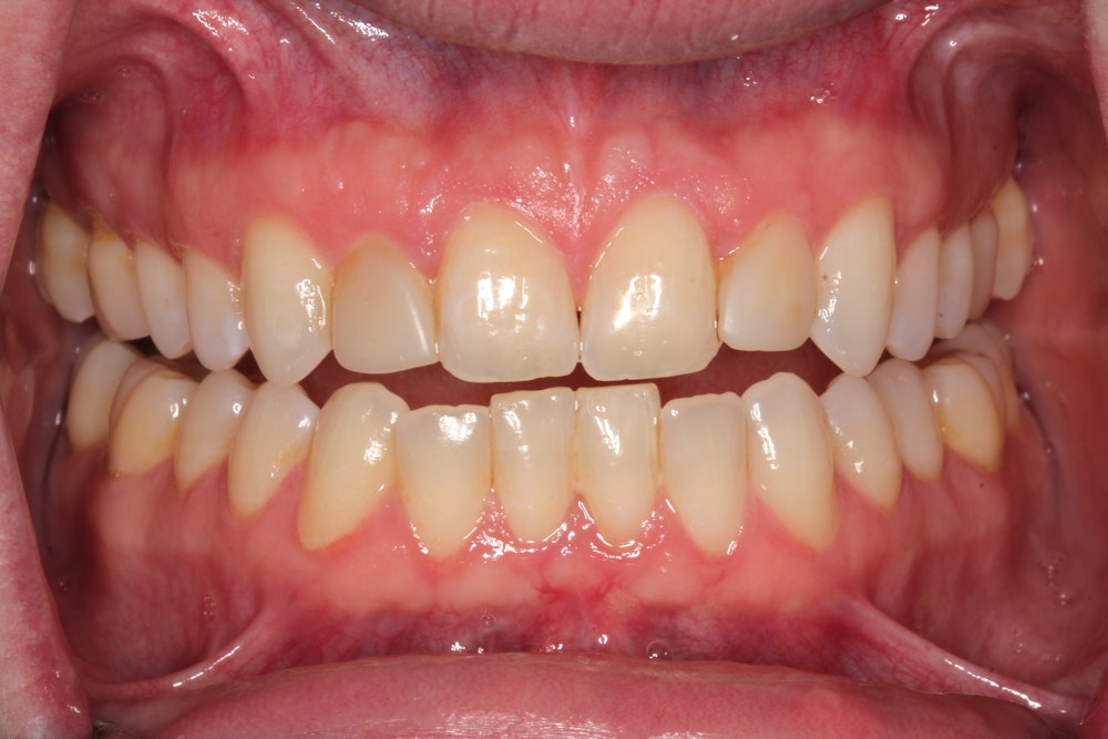 Before whitening