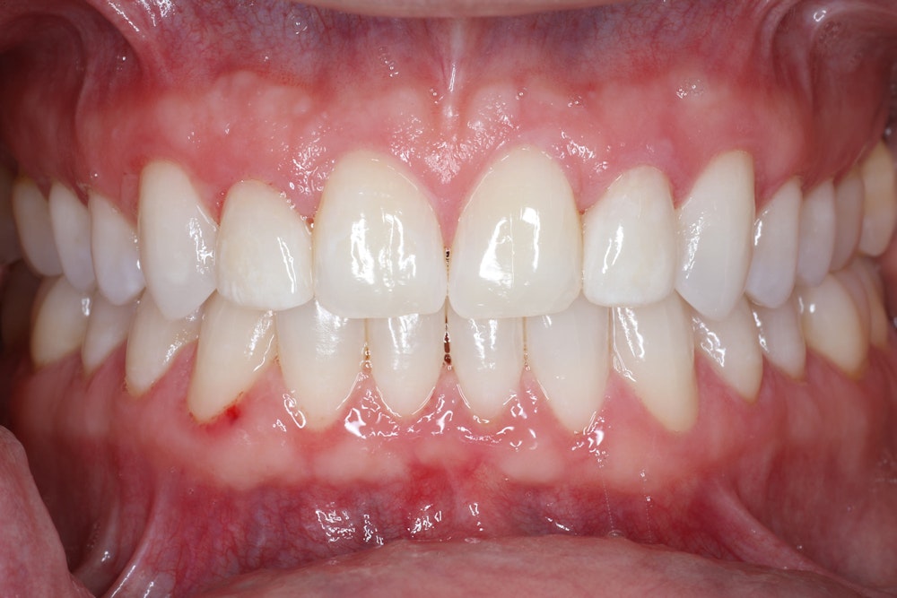 After whitening